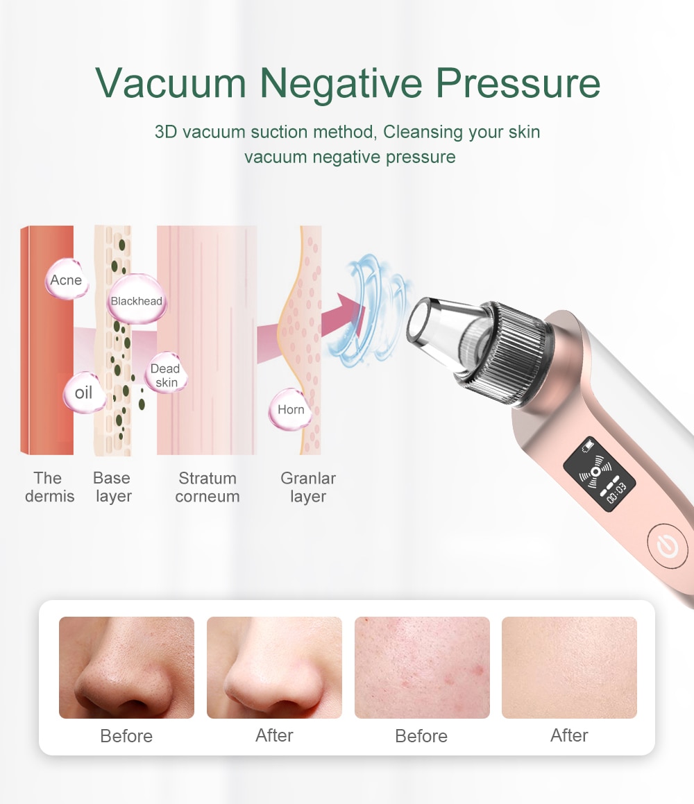 Blackhead Remover Vacuum for Pore Cleaning